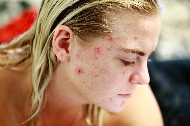 What's your type of acne? And what your acne telling you. 19